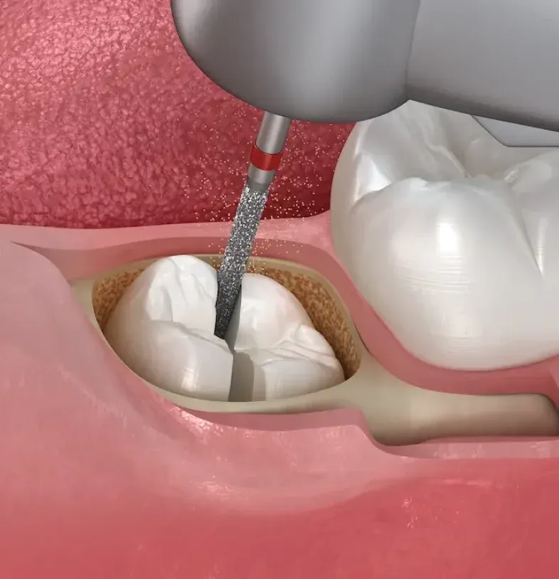 Dental Crown Types