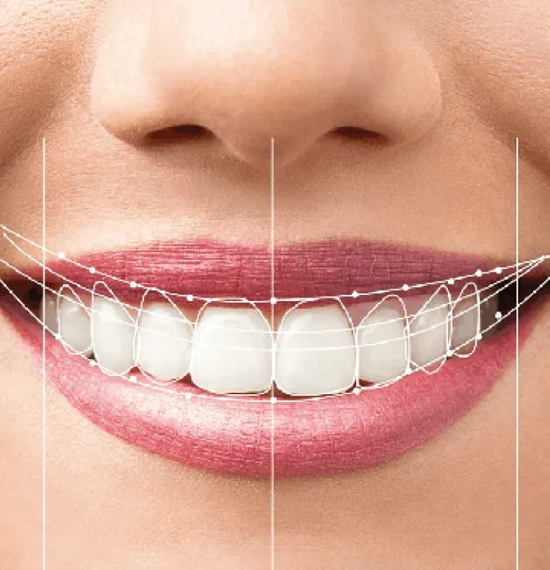 Dental Crown Types