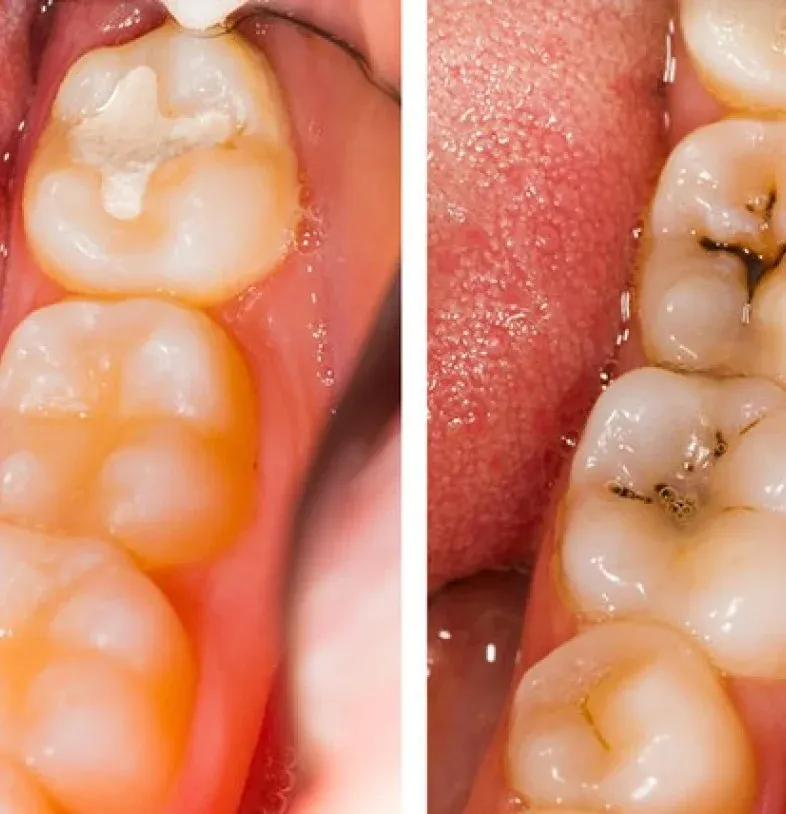 Dental Crown Types